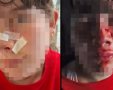 הילדה שהותקפה בידי תן בכינרת(קרדיט: באדיבות המשפחה)