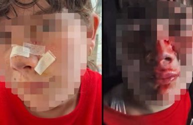 הילדה שהותקפה בידי תן בכינרת(קרדיט: באדיבות המשפחה)